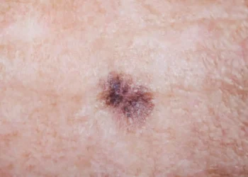 Melanoma, el cáncer que provoca más fallecimientos