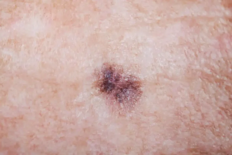 Melanoma, el cáncer que provoca más fallecimientos