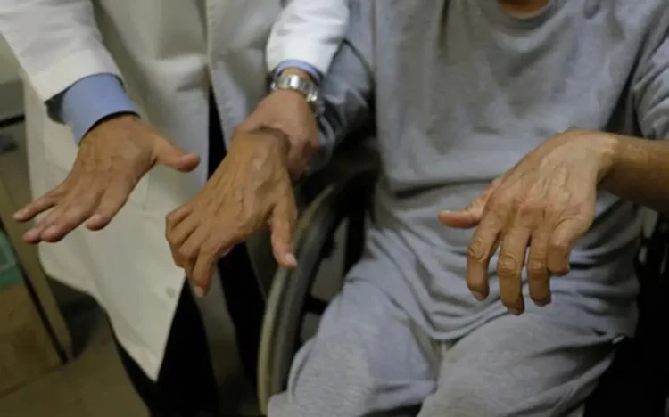 Refuerza IMSS Chiapas detección oportuna de artritis reumatoide